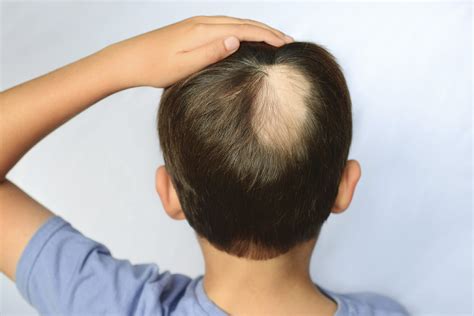 Preferred Treatment in Pediatric Alopecia Areata - Dermatology Advisor