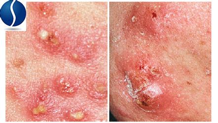 Gross Skin Conditions