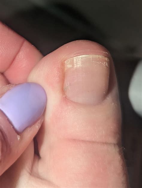 Line under toenail? : r/DiagnoseMe