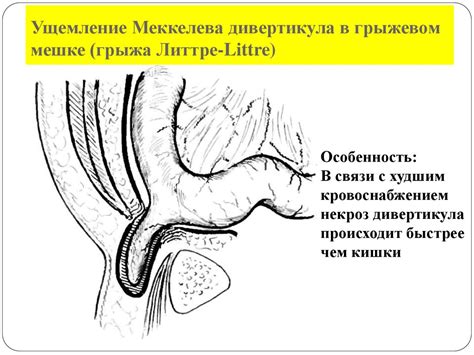 Виды ущемлений грыж - презентация онлайн