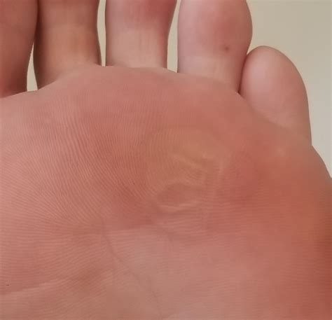 My blister healed, now my foot print has a 5 : r/mildlyinteresting