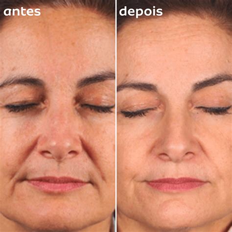 Vitacid Antes E Depois Rugas - Preenchedor de Rugas Bisyou: antes e depois!