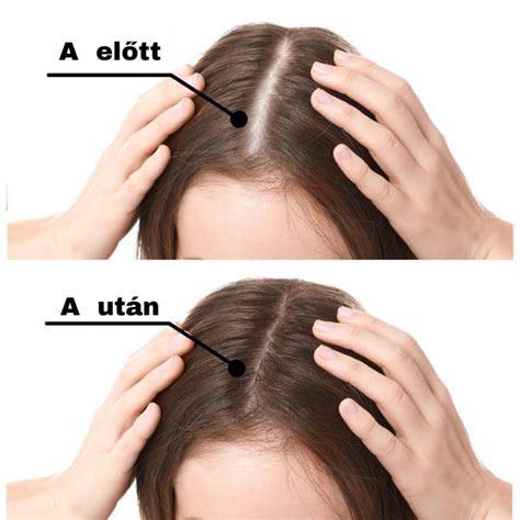 Hajnövesztő oldat nőknek, Minoxidil iiSolutions 2%, 1 hónapos ...