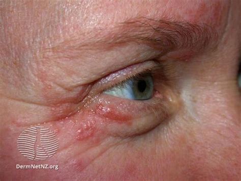 Perioral dermatitis - WikiProjectMed