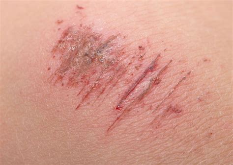 Types of Wound - Dr Sabharwal's Wound Care