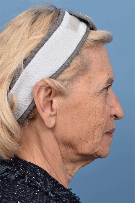 contoura lift  ponte vedra beach contoura