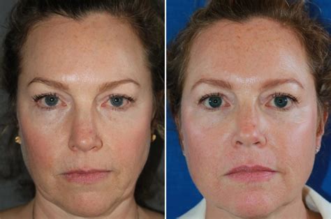 Kleresca Skin Rejuvenation Before And After