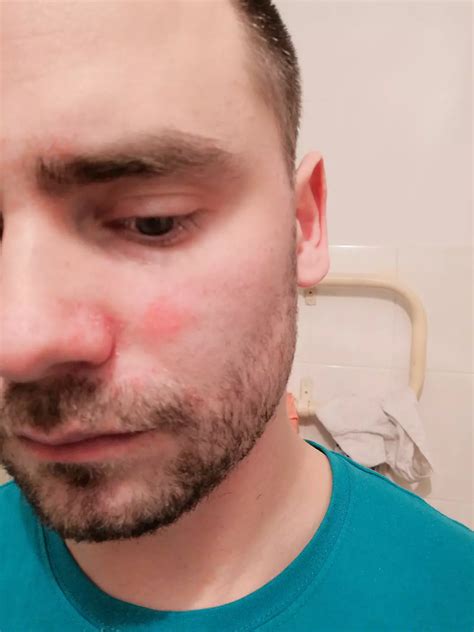 Появилось пятно на щеке Появилось пятно на щеке, увеличиваеться ...