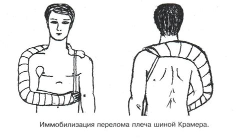 Наложение транспортной шины Крамера на верхнюю конечность
