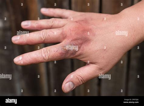 degree burn treatment symptoms  pictures