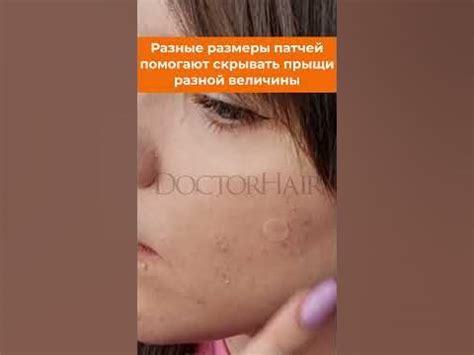 Sevich (Севич) Патчи от прыщей и акне, заживляющие пластыри против ...