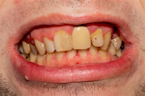 dirty teeth stock  pictures royalty  images istock
