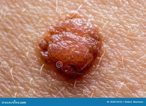 Papilloma Nevus Or Mole On Human Skin Stock Photo | CartoonDealer.com ...