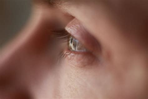 Rash Around Eyes: Overview, Causes, And Treatment