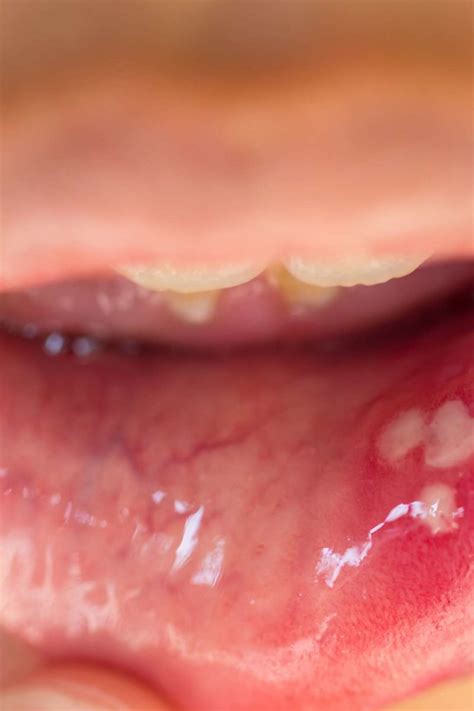 Hpv Tongue Lesions