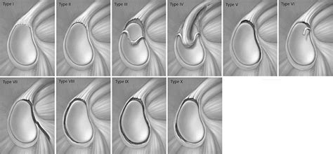 SLAP Lesion: Part I. Pathophysiology and Diagnosis | Musculoskeletal Key