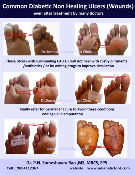 healing diabetic ulcer locations dr somesh diabetic foot clinic