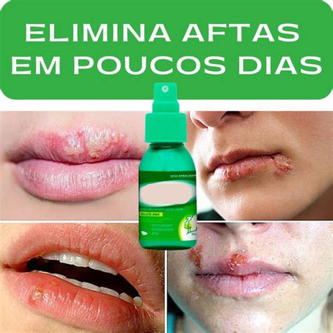 O Que É Bom Para Afta Nos Labios