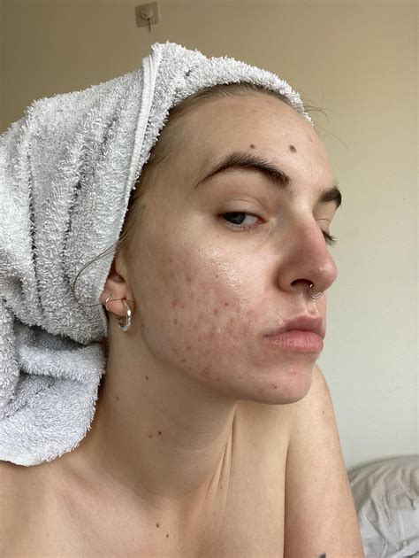 will my scars ever go away?? : r/Accutane