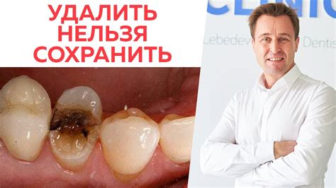 Удалить зуб или оставить? \ Как решает врач, когда удалить зуб, а когда ...