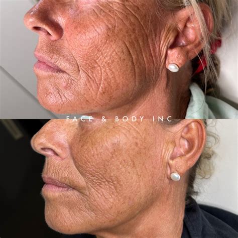 iPixel Laser Resurfacing - Skin Resurfacing Perth - Face and Body Inc