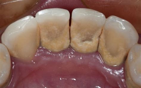 Bacterial plaque: Find out what it is and how you can fight it🦷 — ProDent