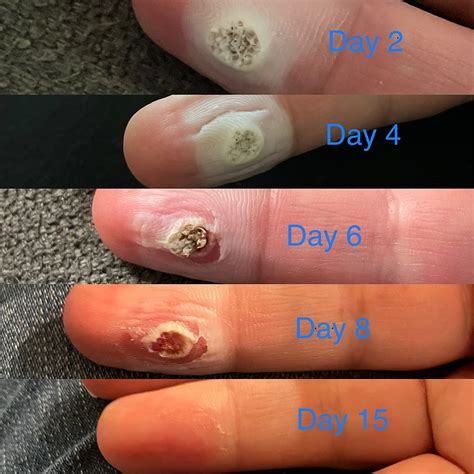 Freezing Stages Of A Wart Falling Offpittube - Stories