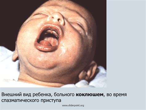 Коклюш - Презентация Медицина