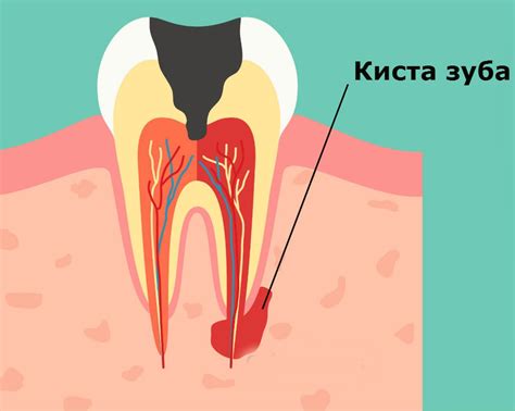 Киста на корне зуба, цистэктомия зуба лечение и удаление