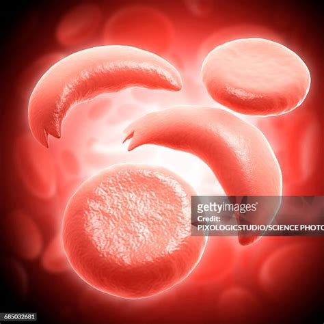 Sickle Red Blood Cell Photos and Premium High Res Pictures - Getty Images