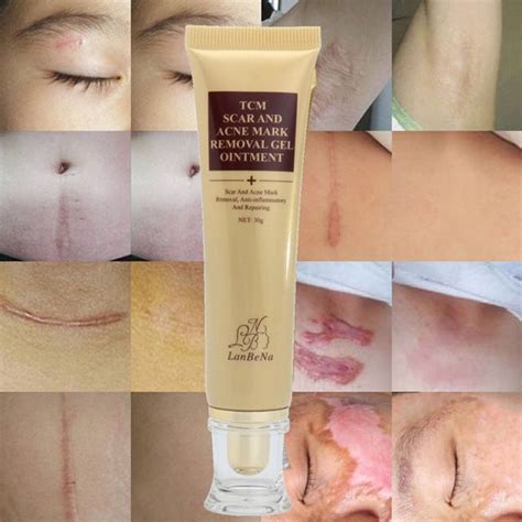 TCM Scar and Mark Removal Gel Landena Acne Cream 30g at 990.00 from ...