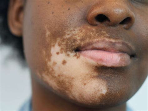 Vitiligo: 10 Vitiligo Symptoms