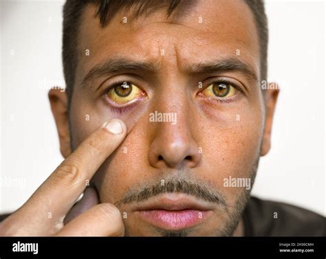 Liver disease yellow eyes skin hi-res stock photography and images - Alamy