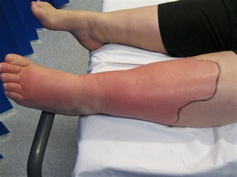cellulitis eron classification antibiotics geeky medics