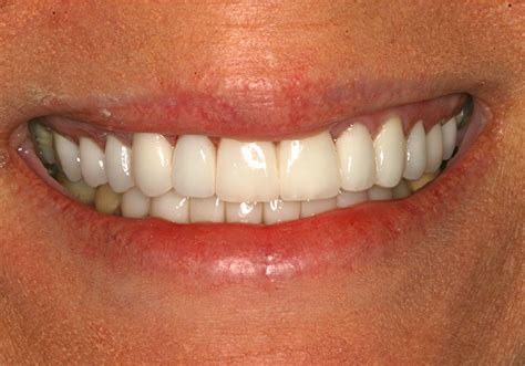 Dentist Huntsville TX | Dr. Scott A. Logan | Veneers