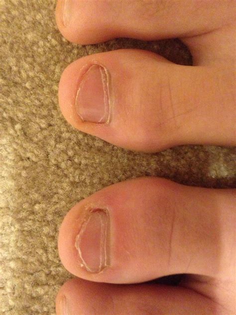 Is this an ingrown toenail? (Other toe for reference) it hurts when I ...