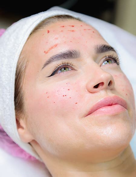 acne treatment fbr  skin lounge