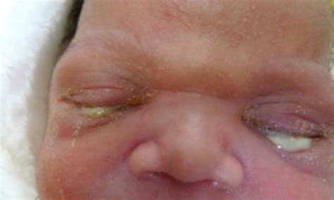 nhs newborn eyes