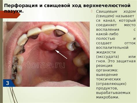 Одонтогенный гайморит. Клиника, диагностика, лечение. Перфорация и ...