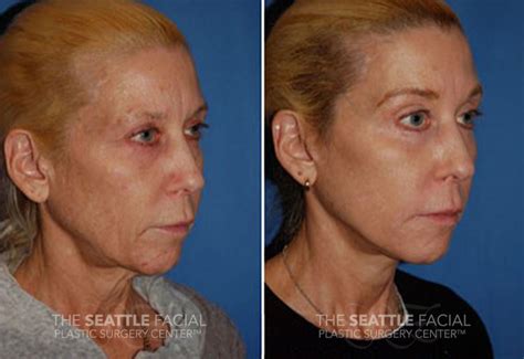 Dermabrasion Photo Gallery - Before and Afters
