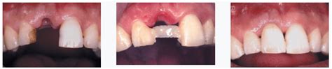 Root Canal Alternatives | Holistic Dental Treatment | Pure Holistic Dental
