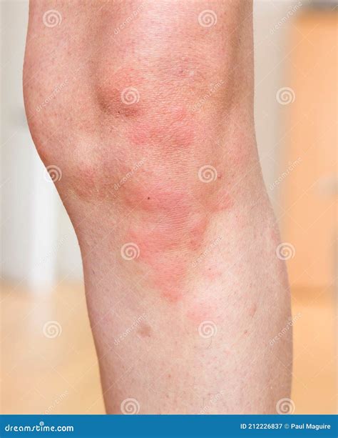 Hives Rash Urticaria, Skin Condition, Skin Allergy on Body, UK Stock Image - Image of asian