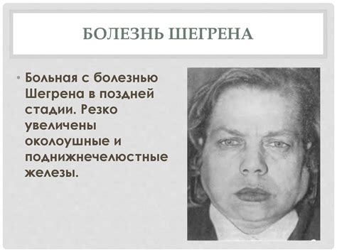 Болезнь Шегрена - презентация онлайн