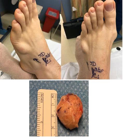 soft tissue mass excisions