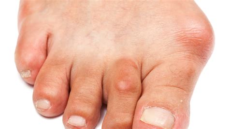 Foot Bunion - Causes, Symptoms, and Treatment To Correct Bunion