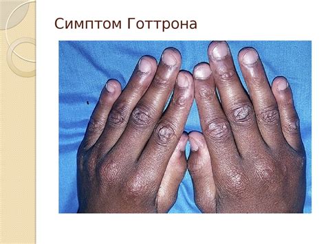 Дерматомиозит - презентация онлайн