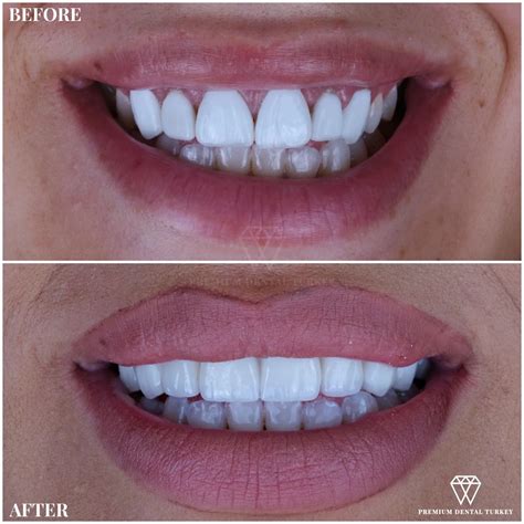 What is the Difference between Emax Crowns and Zirconium Crowns