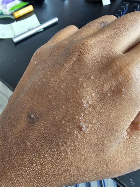 Bumps all over body? : r/DermatologyQuestions