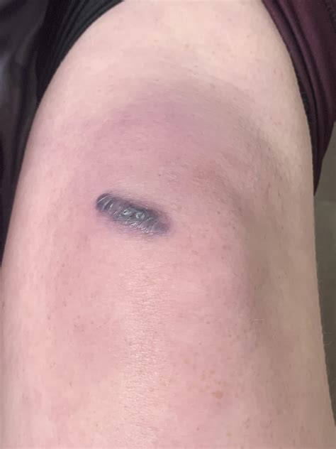 pls tell me my knee isn't decaying or something : r/InjuriesAndWounds