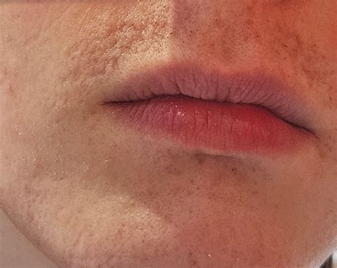 Overtreatment and scarring - what to do next? - Professional